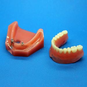M-6007 Modello odontotecnici per la riparazione impianto dentale