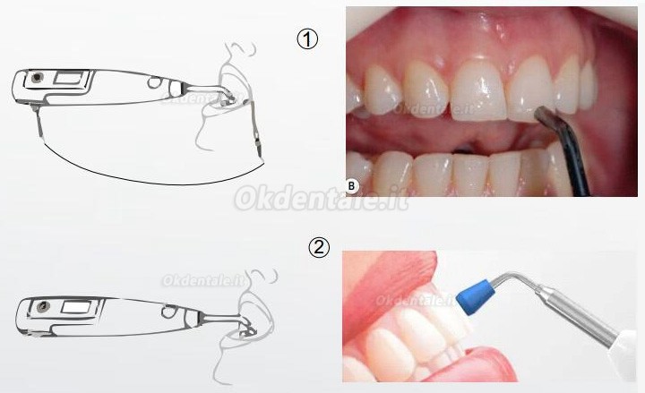Sistema integrato Endo dentale Denjoy MeteEndo (con Meta Fill/Meta Pex/Meta Motor/Meta Pulp/Meta Pack)