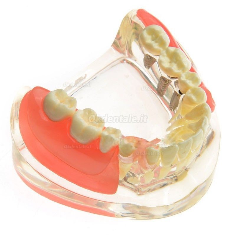 M-6006 Modello odontotecnici Restauro implantare per molari perduti