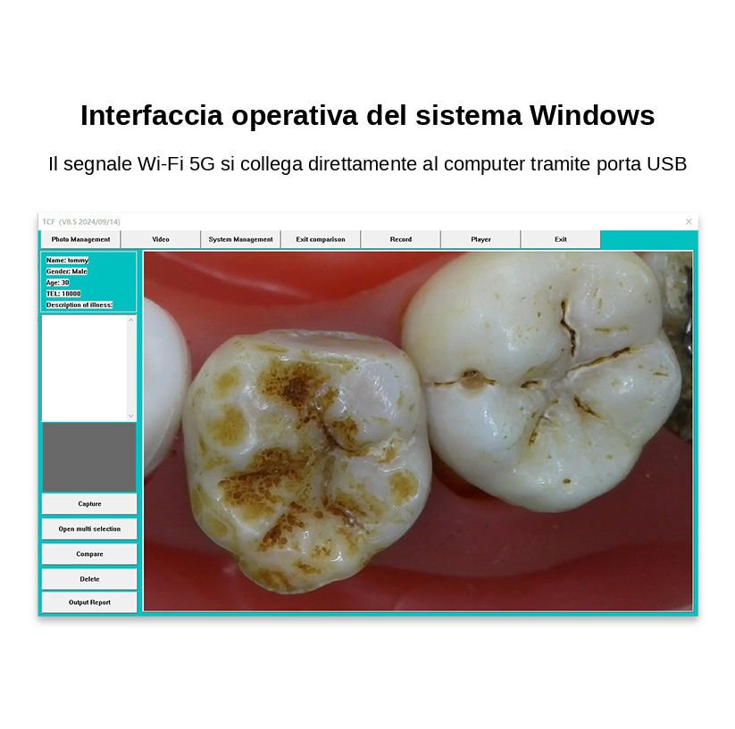 Telecamera intraorale wireless per odontoiatria MLG CF680, 1080P, con 8 luci LED Telecamera intraorale wireless per odontoiatria MLG CF680, 1080P, con 8 luci LED