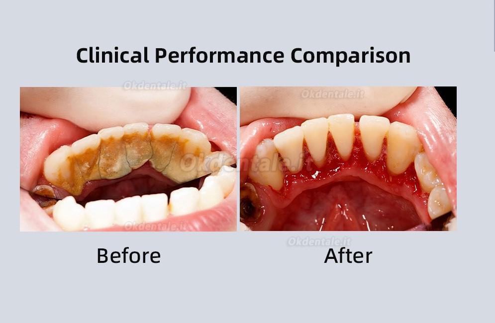 Ablatore ultrasonico dentale digitale PlusPower Vanta