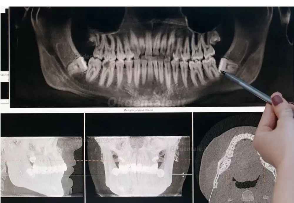 Refine MaxSurgery Unità per piezochirurgia (chirurgia piezoelettrica odontoiatria) Refine MaxSurgery Unità per piezochirurgia (chirurgia piezoelettrica odontoiatria)