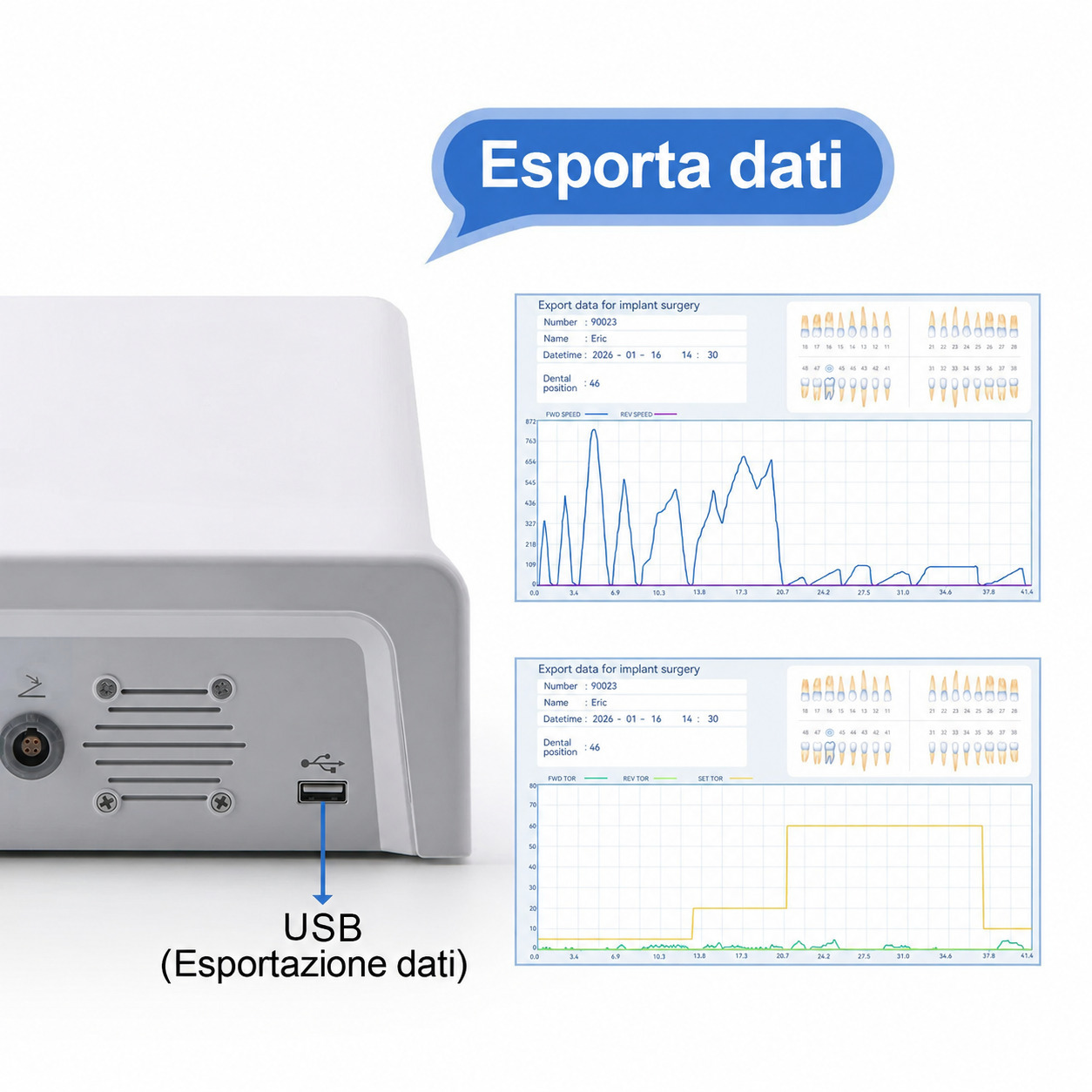 Sistema a motore per implantologia dentale Betterway Surgic G3 + manipolo contrangolo 20:1 Sistema a motore per implantologia dentale Betterway Surgic G3 + manipolo contrangolo 20:1
